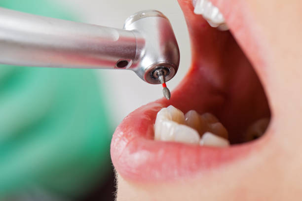 Best Broken or Chipped Tooth Repair in Pleasant Valley, MO